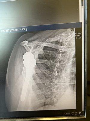 X-ray of my shoulder replacement from the back of the arm.