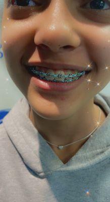 With braces