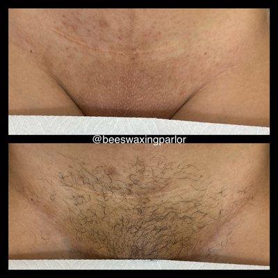 Before and after of a Brazilian wax.