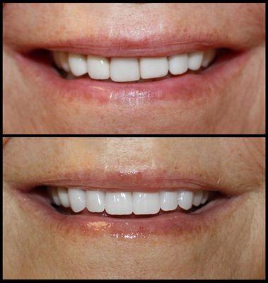 Veneers and Crowns