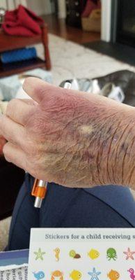 My hand after an IV was insterted Friday night after they sent me home with a Benadryl and 194 BP