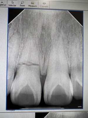 Fractured front tooth due to an accident getting replaced by an immediate implant supported restoration