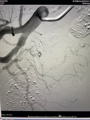 Outpatient prostate embolization for BPH