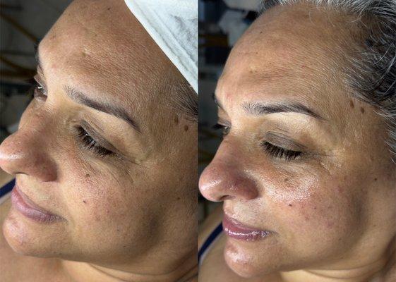 Before and after - Glow2facial detox Client.