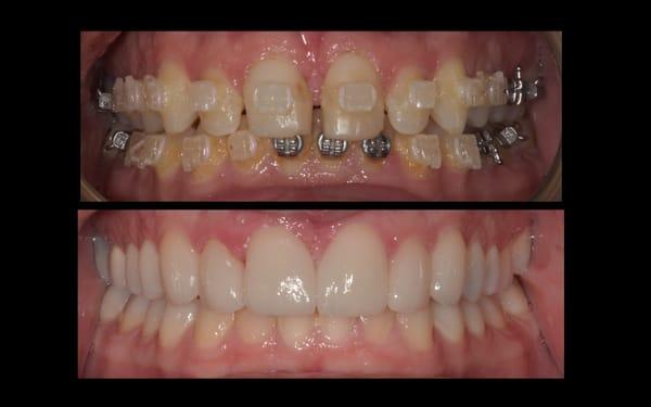 Beautiful results from in-office bleaching and six upper veneers.