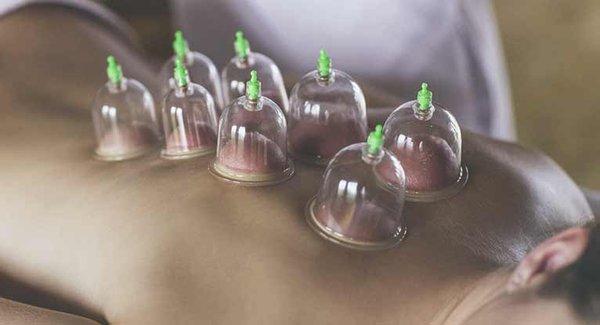 Cupping