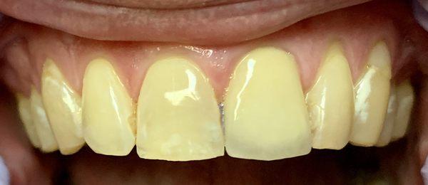 Crowns protect teeth , fix chips and fractures , enhance shape and color and/or match adjacent teeth.