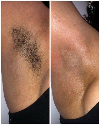 Before and After Underarm Wax