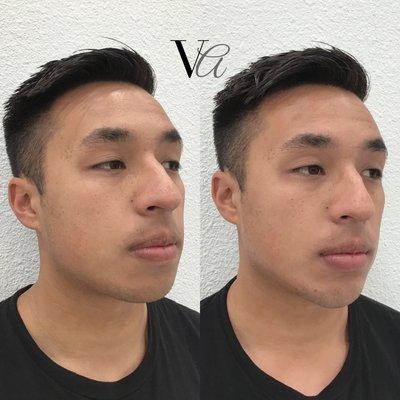 Jawline Dermal Filler