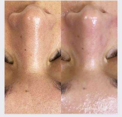 The Platinum Hydrofacial- A deep detoxing cleansing customized treatment