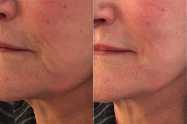 Before and After juvederm lines and lips