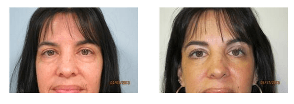 Before & after photo of an eyelid procedure