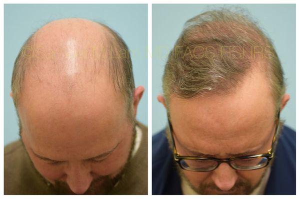 This 63-year-old patient is shown before and seven months following a hair transplant into his frontal/midscalp and crown.