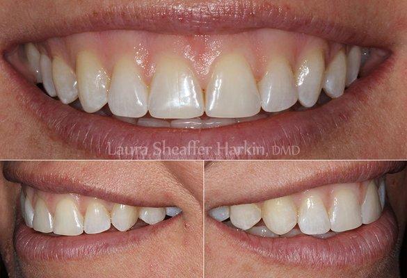 Dr. Harkin is a Certified Invisalign Provider