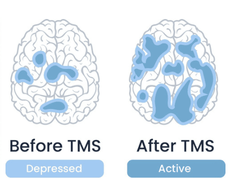 Effects of Transcranial Magnetic Stimulation on the brain