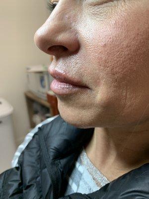 After Lip Augmentation