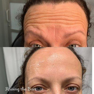 Botox and microneedling