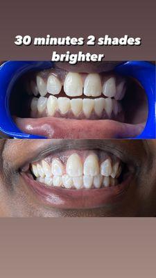 30 Min of Teeth whitening results