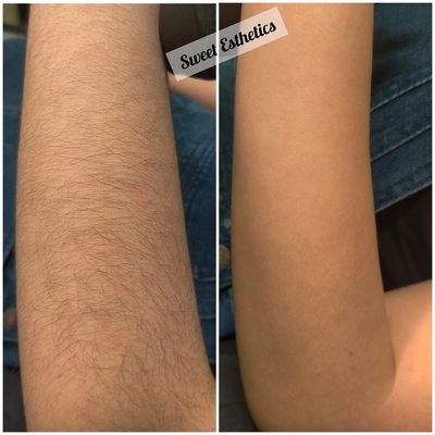 Arm Sugaring