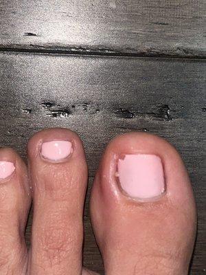 Infected toe nail.