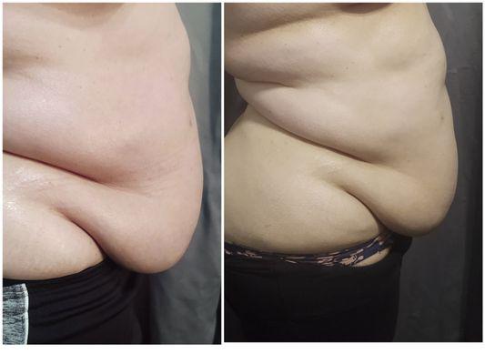 Body Contouring is painless , non invasive treatments that can aid in inch loss