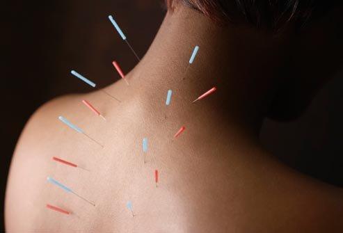 Neck and shoulder pain reduce by needle treatment