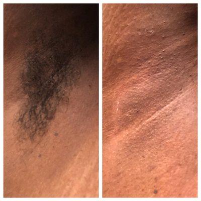 Before & after photos of an underarm waxing. I used @starpilwax pink polymer wax for a painless wax experience.