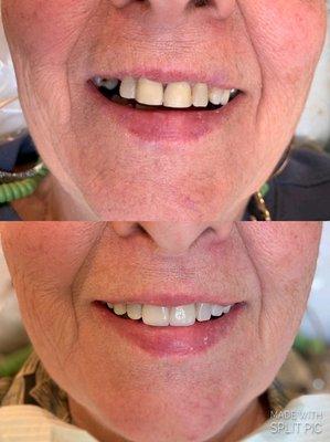 Replaced her crowns that she was unhappy with and worked with her budget to improve her smile functionally and cosmetically.