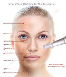 Microneedling