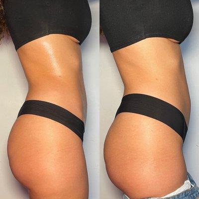 Body contouring by Keira