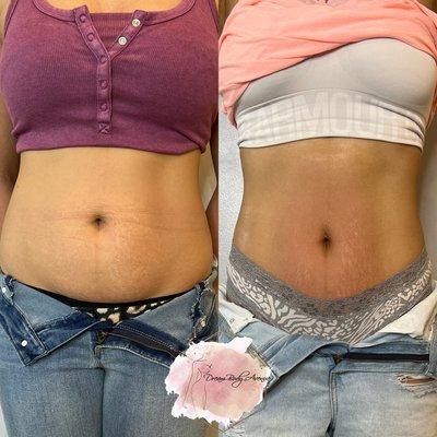 By liquifying the fat and tightening the skin, we achieved these great results with several sessions!