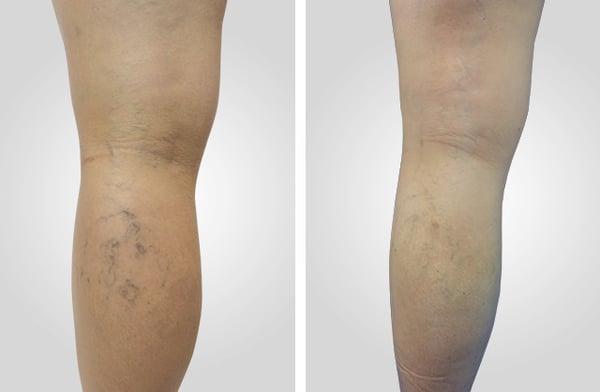 Spider Veins Before & After Treatment