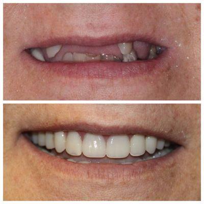 Dentures can give you back your teeth so you can smile and eat again! We even placed 2 implants for this patient, so her dentures snap in!