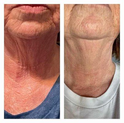 Fractora laser treatment