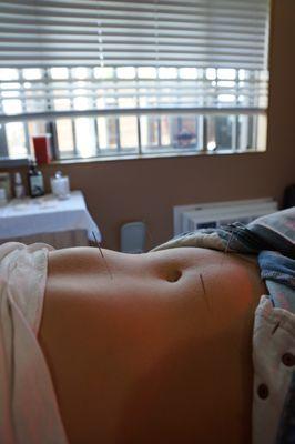 Acupuncture for digestion