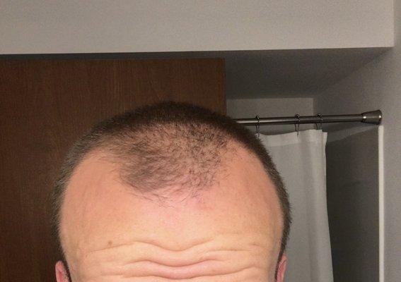 My degree of hair loss, taken the morning of surgery.