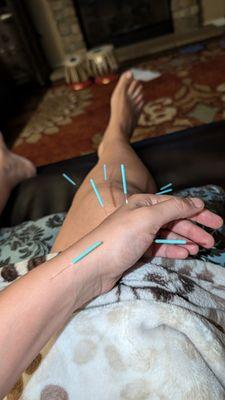 Acupuncture for knee pain and thumb arthritis