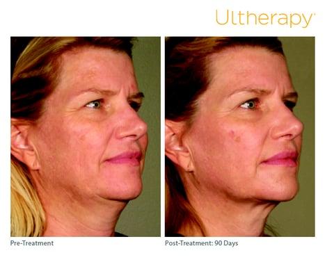 Ultherapy is perfect for tightening the skin of the neck and face