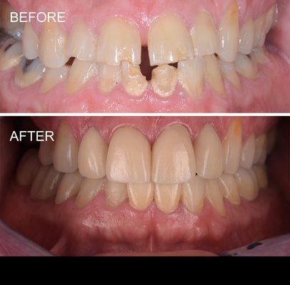 Porcelain crowns to correct diastema & chipped teeth