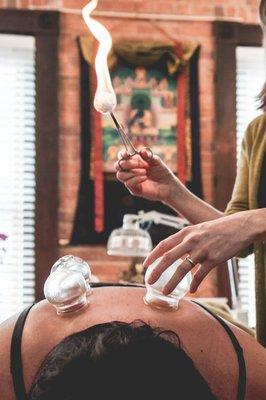 Fire Cupping for pain and tension relief