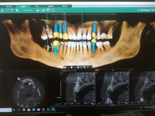 New Age  Dentistry.
Technological advances make Implants the best choice for broken or missing teeth.