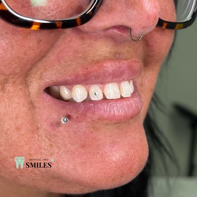 Cute tooth gem chandler Arizona by official pro smiles