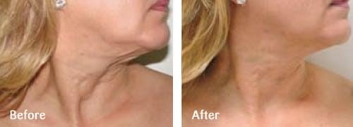 Tone and lift sagging skin