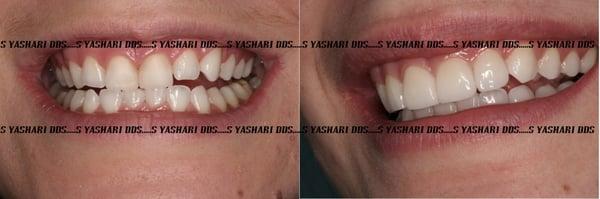 Custom Veneers