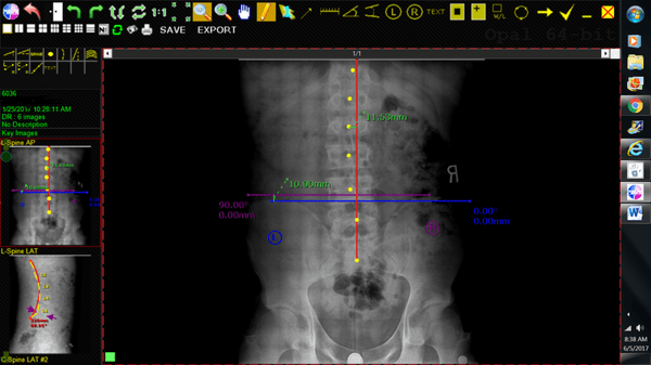 Significant Objective Improvement from 'Corrective Care' plan - BEFORE