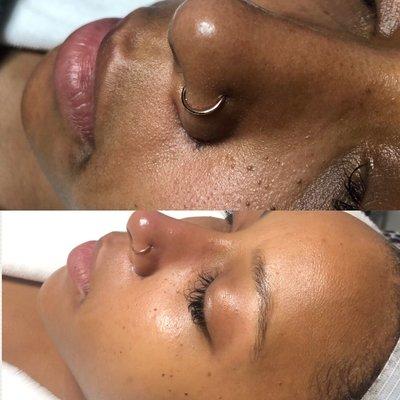 Brightening Facial