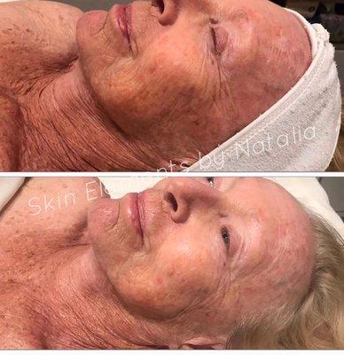 Dermal Lift Treatment