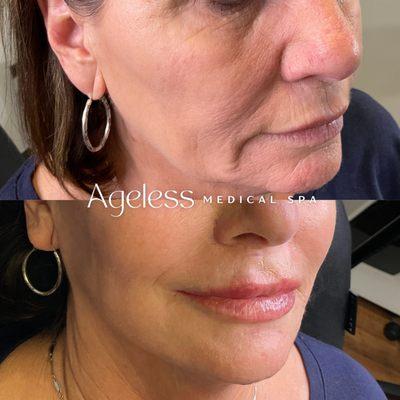 Ageless Filler Results