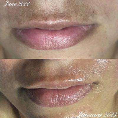 Before and after. Client's concern: melasma and pigmentation.