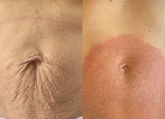 Fibro blast plasma pen 
Stretch marks  removed 

Skin tightening